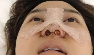 鼻子整形需要多少钱